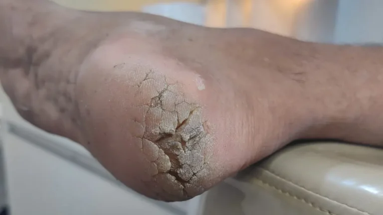 rachadura nos pés