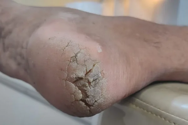 rachadura nos pés